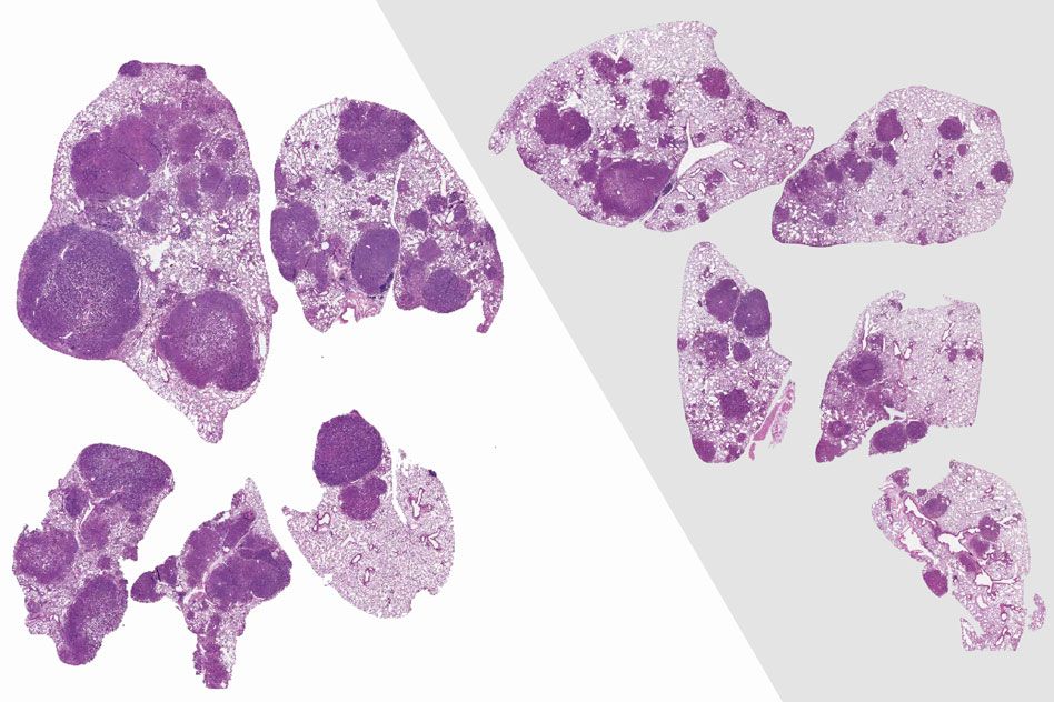 Bacteria promote lung tumor development, study suggests