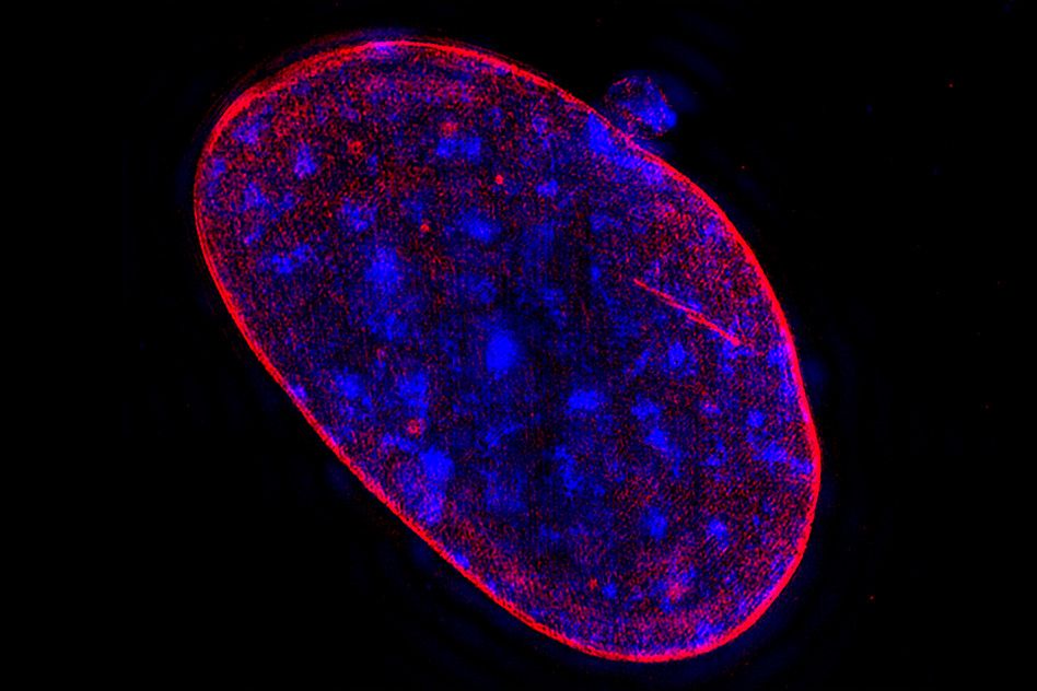 Measuring chromosome imbalance could clarify cancer prognosis